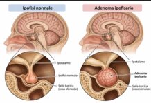 Ipofisi e adenoma ipofisario: la ghiandola maestra e le sue alterazioni